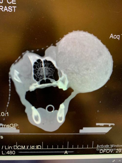 He needed to undergo radiation treatment sessions and also suffered from the disease called heartworm.